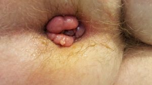 anal warts left untreated